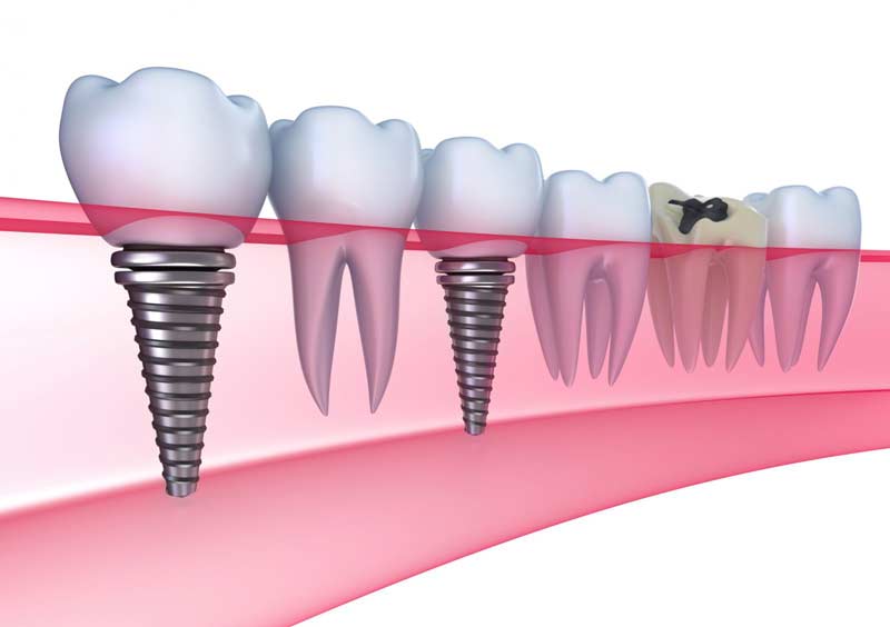 koliko kosta zubni implant