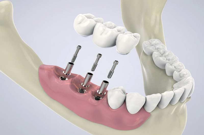 Koliko kosta zubni implant