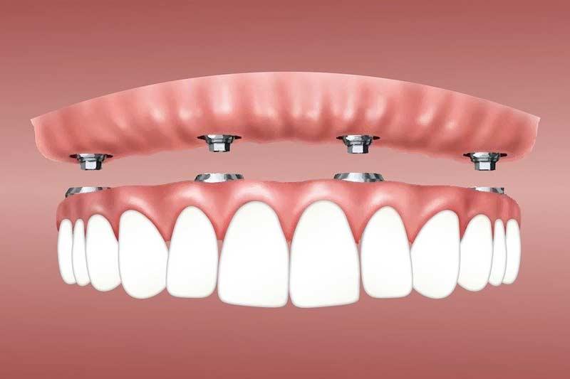 Koliko kosta implantat