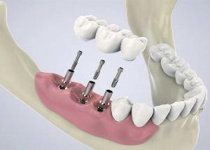 Koliko kosta zubni implant