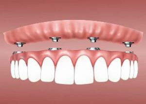 Koliko kosta  implantat